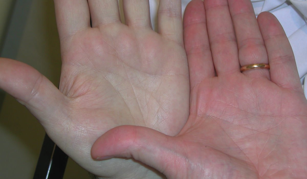 Симптоми по дланите, които подсказват заболяване