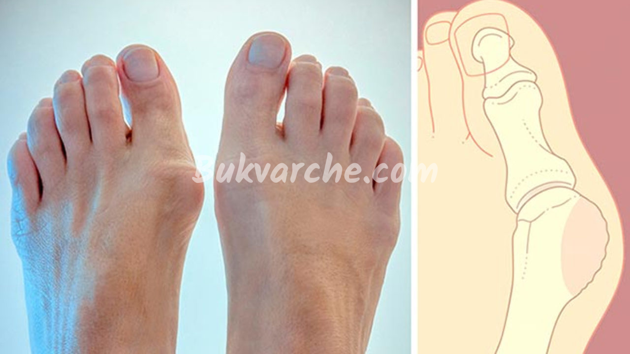 Кокалче на палеца на крака: Народни средства