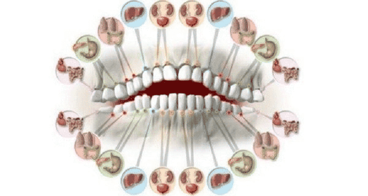 Уврежданията на зъбите прогнозират проблеми с органите